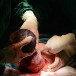 C Section Cesarean Section Purpose Procedure and Risk