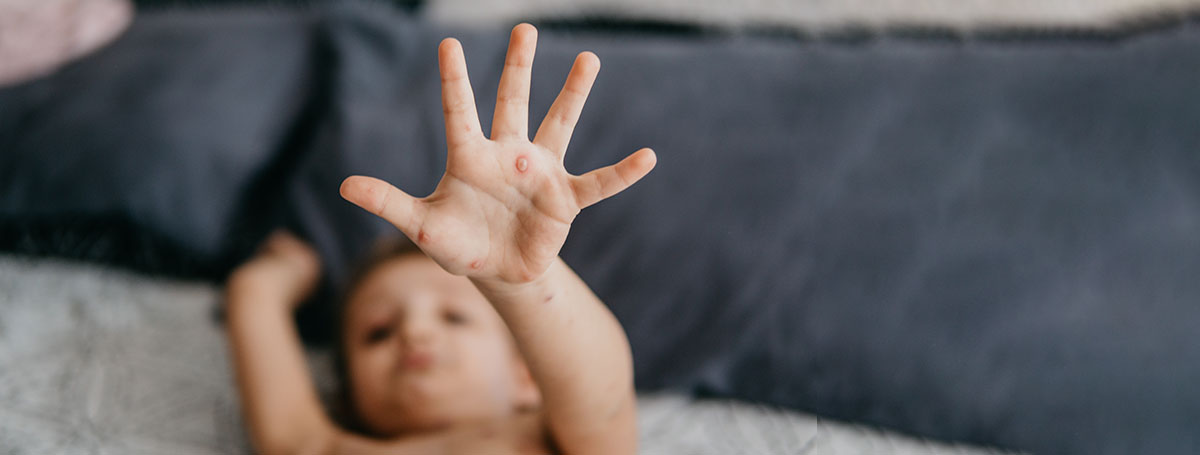 Chickenpox in Children Symptoms Diagnosis and Treatment