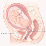Cervix Length and Its Role in Normal Delivery: Everything You Need to Know
