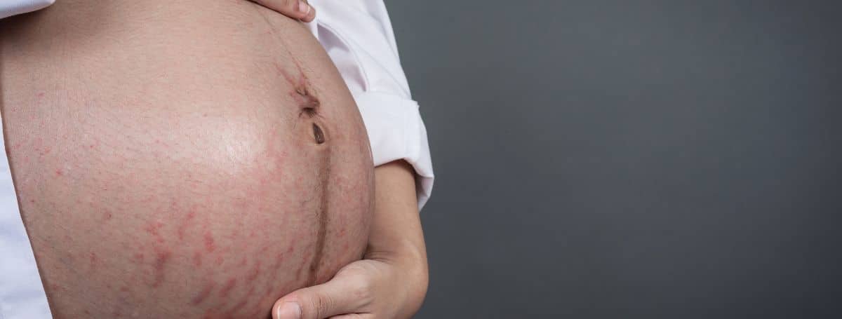 PUPPP Pregnancy Rash: Symptoms, Safe Home Relief